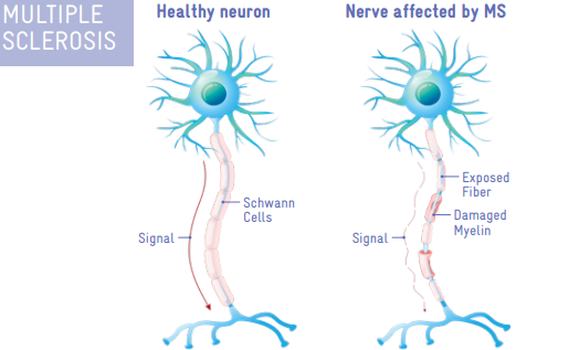 Drawing of a healthy neuron next to an image of a neuron affected by MS.